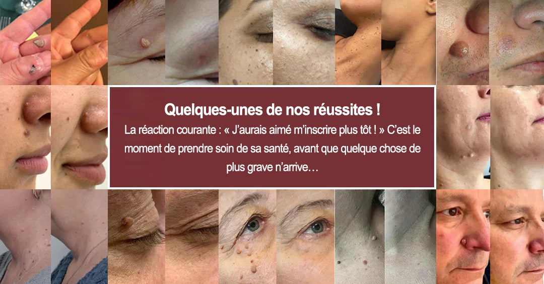 💖Patch 2-en-1 Curalona® : Microneedle & Hydrocolloïde🍀 | Élimine les grains de beauté en relief, les verrues planes et les acrochordons | Aide à atténuer les rides, les cicatrices et les imperfections | Patch invisible adapté au visage et au corps