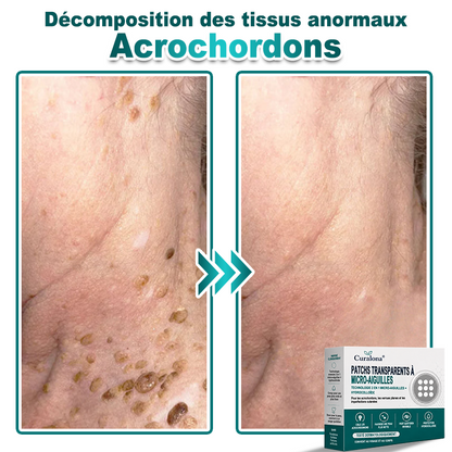🏥Pharmacie en ligne française🔥 Curalona® Patch 2-en-1 à Micro-Aiguilles & Hydrocolloïde | Pour les Acrochordons, les Verrues Plates et les Excroissances Cutanées Indésirables | Amélioration Visible dès 5 Jours