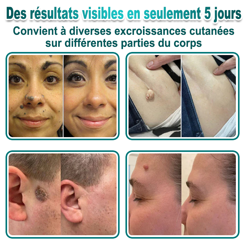 🏥Pharmacie en ligne française🔥 Curalona® Patch 2-en-1 à Micro-Aiguilles & Hydrocolloïde | Pour les Acrochordons, les Verrues Plates et les Excroissances Cutanées Indésirables | Amélioration Visible dès 5 Jours