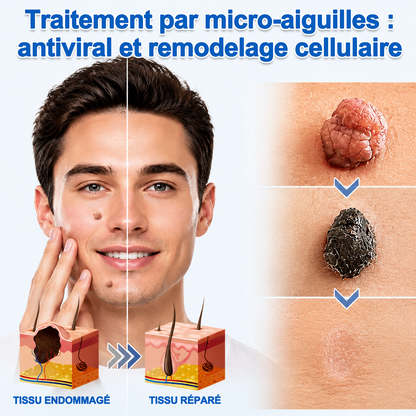 💖Patch 2-en-1 Curalona® : Microneedle & Hydrocolloïde🍀 | Élimine les grains de beauté en relief, les verrues planes et les acrochordons | Aide à atténuer les rides, les cicatrices et les imperfections | Patch invisible adapté au visage et au corps