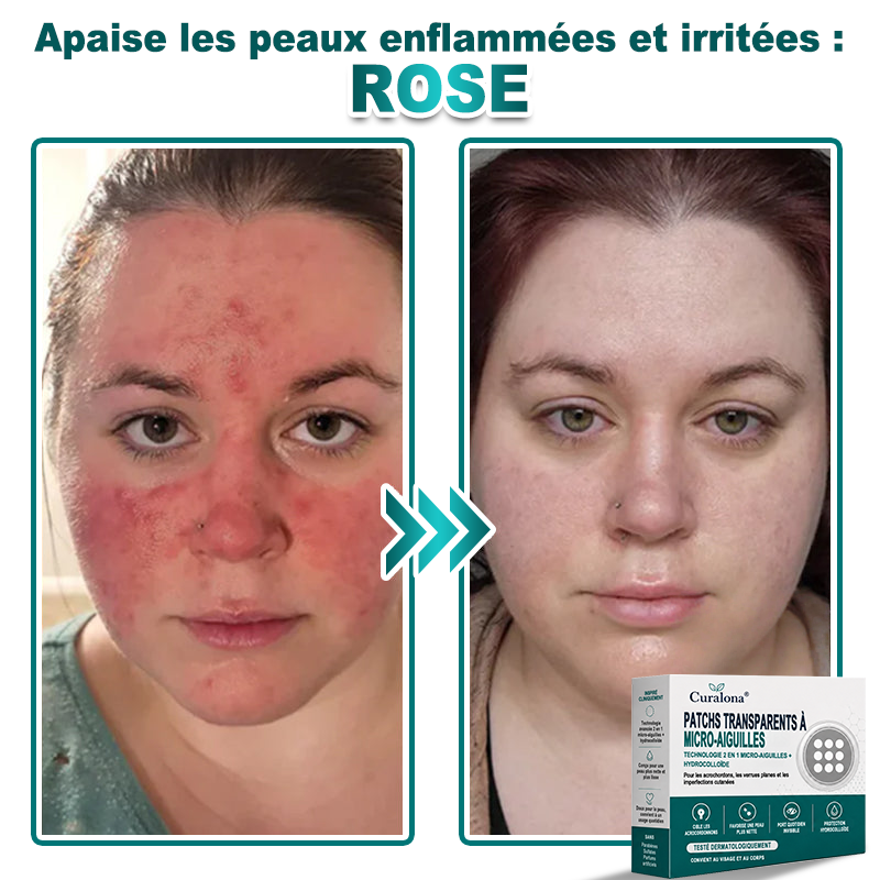 🏥Pharmacie en ligne française🔥 Curalona® Patch 2-en-1 à Micro-Aiguilles & Hydrocolloïde | Pour les Acrochordons, les Verrues Plates et les Excroissances Cutanées Indésirables | Amélioration Visible dès 5 Jours
