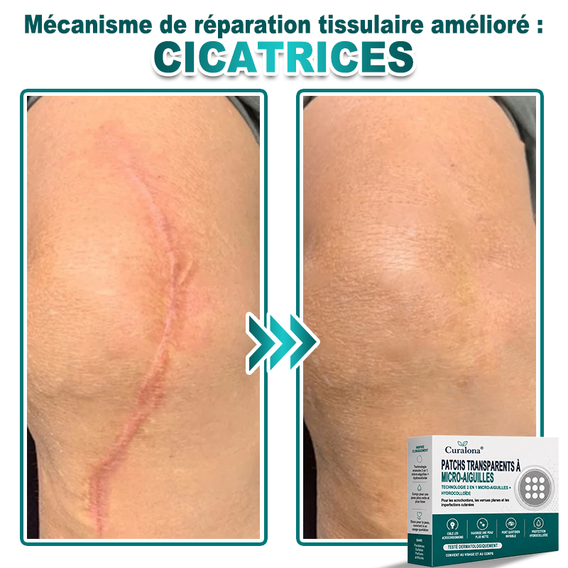 🏥Pharmacie en ligne française🔥 Curalona® Patch 2-en-1 à Micro-Aiguilles & Hydrocolloïde | Pour les Acrochordons, les Verrues Plates et les Excroissances Cutanées Indésirables | Amélioration Visible dès 5 Jours