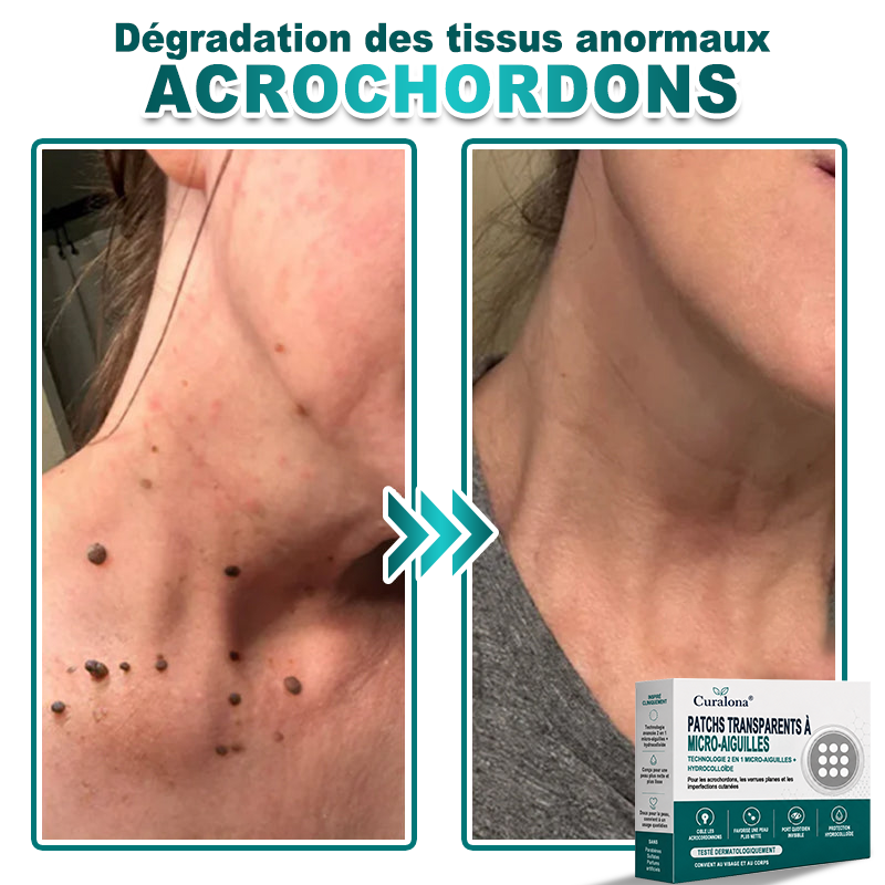 🏥Pharmacie en ligne française🔥 Curalona® Patch 2-en-1 à Micro-Aiguilles & Hydrocolloïde | Pour les Acrochordons, les Verrues Plates et les Excroissances Cutanées Indésirables | Amélioration Visible dès 5 Jours