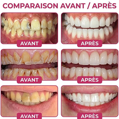 Purelora® DenPerm – Gel de comblement de l’émail naturel pour la réparation des caries