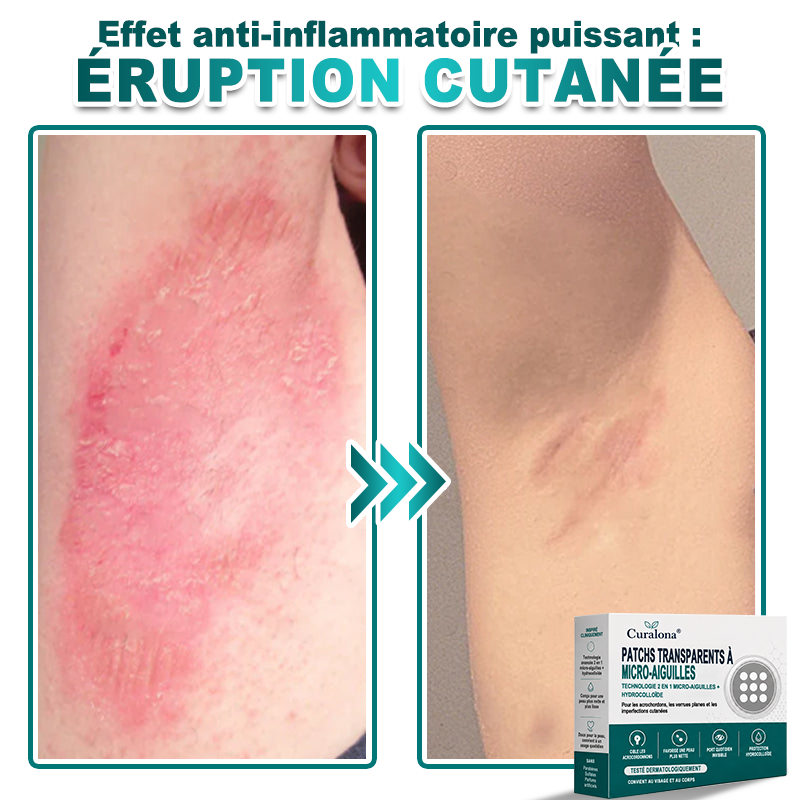 🏥Pharmacie en ligne française🔥 Curalona® Patch 2-en-1 à Micro-Aiguilles & Hydrocolloïde | Pour les Acrochordons, les Verrues Plates et les Excroissances Cutanées Indésirables | Amélioration Visible dès 5 Jours