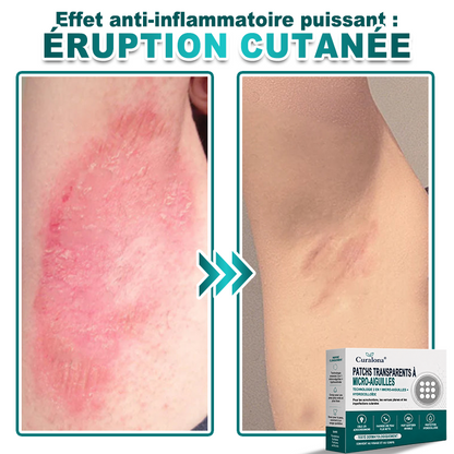 🏥Pharmacie en ligne française🔥 Curalona® Patch 2-en-1 à Micro-Aiguilles & Hydrocolloïde | Pour les Acrochordons, les Verrues Plates et les Excroissances Cutanées Indésirables | Amélioration Visible dès 5 Jours