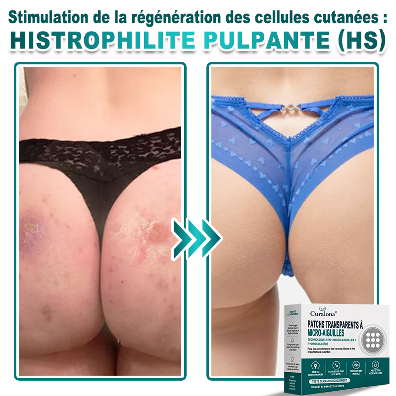 🏥Pharmacie en ligne française🔥 Curalona® Patch 2-en-1 à Micro-Aiguilles & Hydrocolloïde | Pour les Acrochordons, les Verrues Plates et les Excroissances Cutanées Indésirables | Amélioration Visible dès 5 Jours