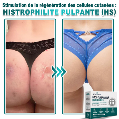 🏥Pharmacie en ligne française🔥 Curalona® Patch 2-en-1 à Micro-Aiguilles & Hydrocolloïde | Pour les Acrochordons, les Verrues Plates et les Excroissances Cutanées Indésirables | Amélioration Visible dès 5 Jours
