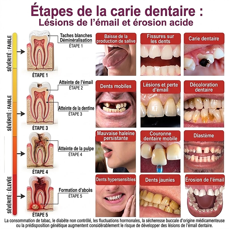 Purelora® DenPerm – Gel de comblement de l’émail naturel pour la réparation des caries