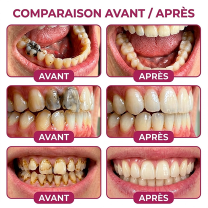 Purelora® DenPerm – Gel de comblement de l’émail naturel pour la réparation des caries